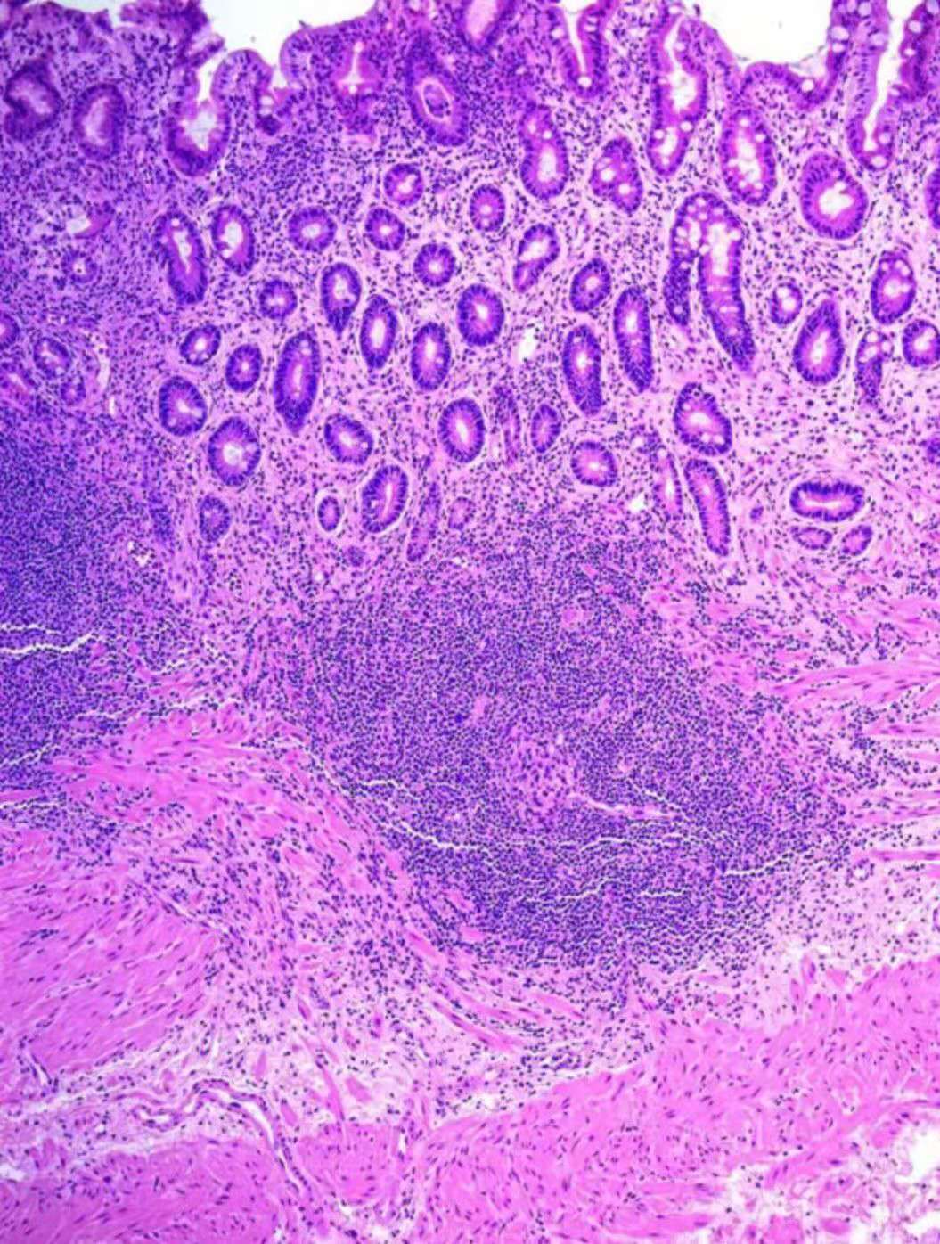 ecd,一种髓系祖细胞恶性肿瘤,已发表文献报道的病例不足1000例