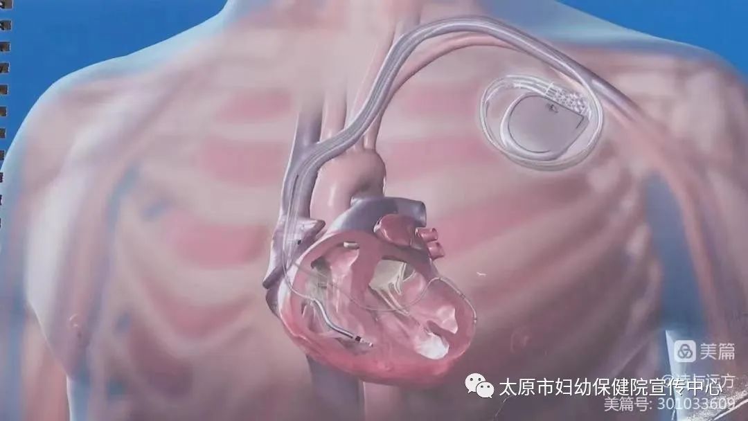太原市妇幼保健院成功实施一例心脏起搏器植入术