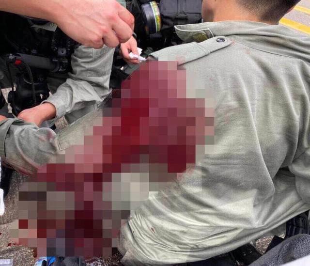 热点|被暴徒刺伤港警受“黄医护”粗暴对待，手术翌日竟被院方催赶出院