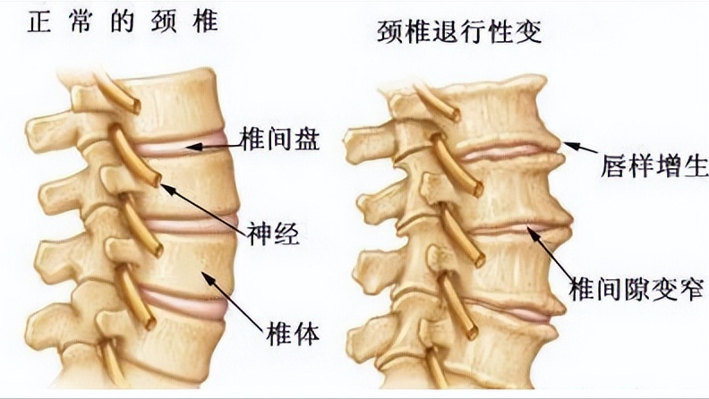 腰間盤突出症,除了藥物治療,康復鍛鍊是否可行?如何做才正確?