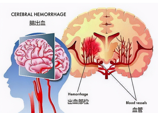 脑出血是怎么引起的图片