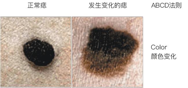 皮肤上有这5个变化,当心癌盯上你