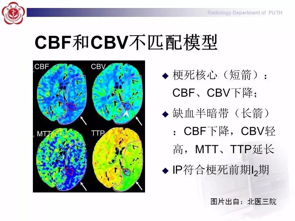 脑灌注成像颜色解读图片