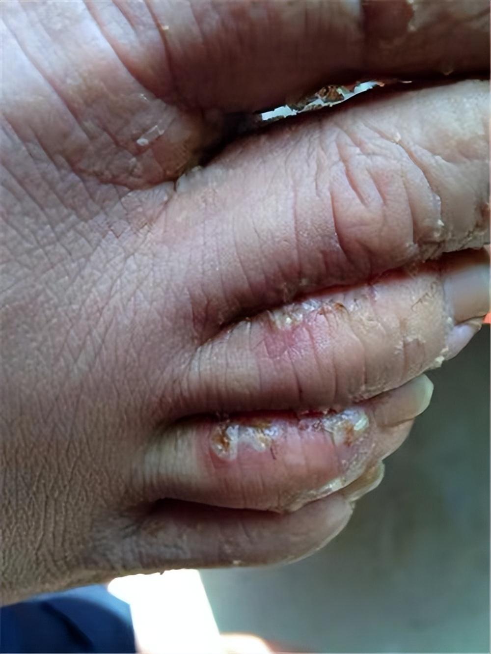 脚趾长水泡瘙痒疼痛?选对这几个国货好物,居家轻松搞定脚气!