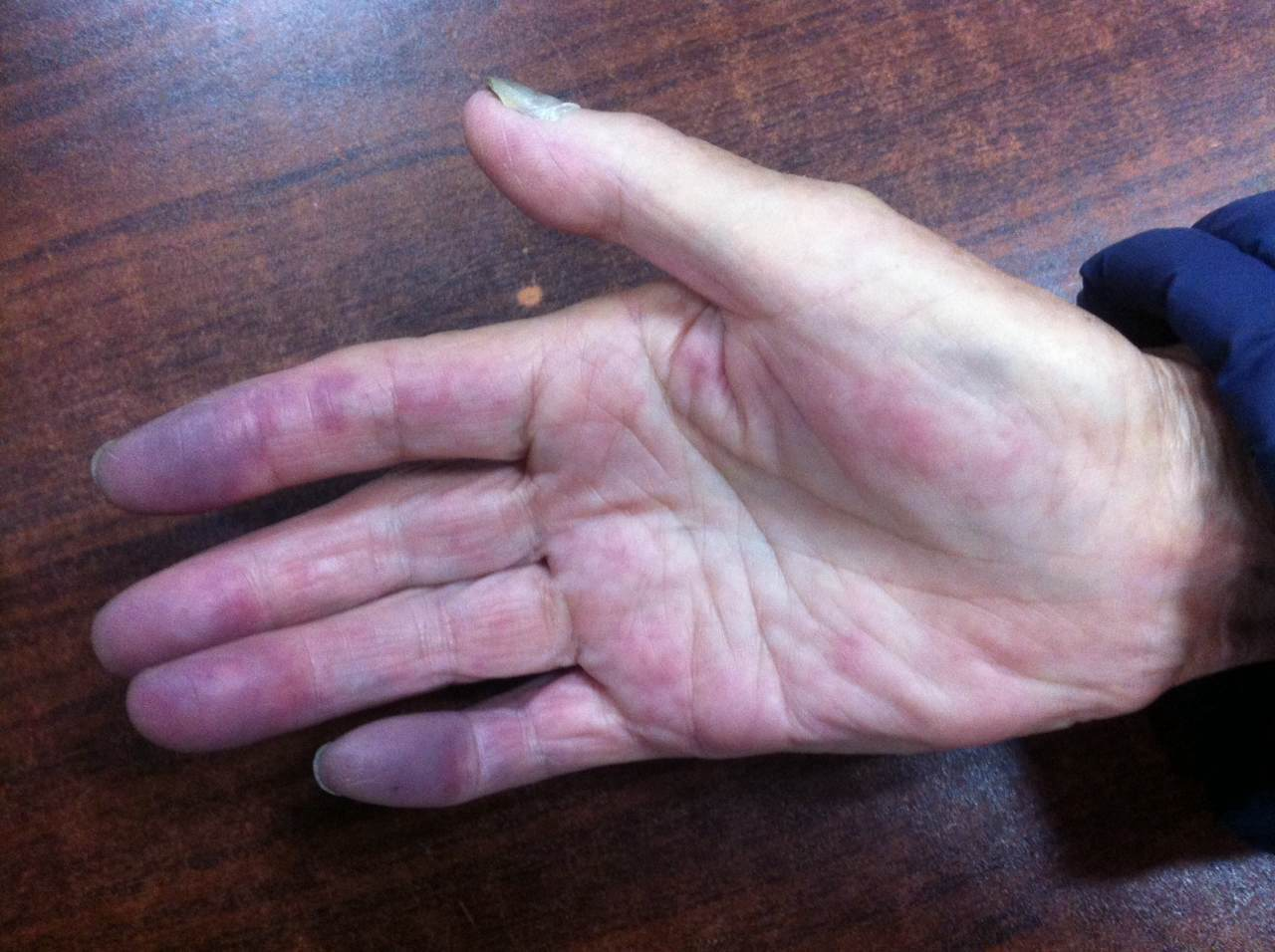 手指静脉血栓症状图图片