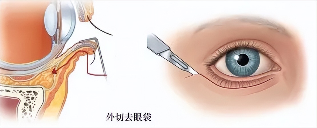 外切眼袋一般要多久才能完全恢复,切除眼袋多久恢复正常,天呐