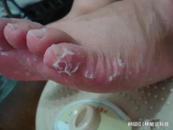 彻底服气了!这个抑菌喷剂太好用了,脚臭脚痒烂脚趾缝28天就好了