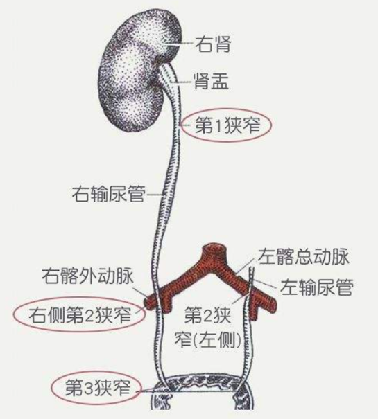 健康科普|上尿路泌尿系结石的保守治疗