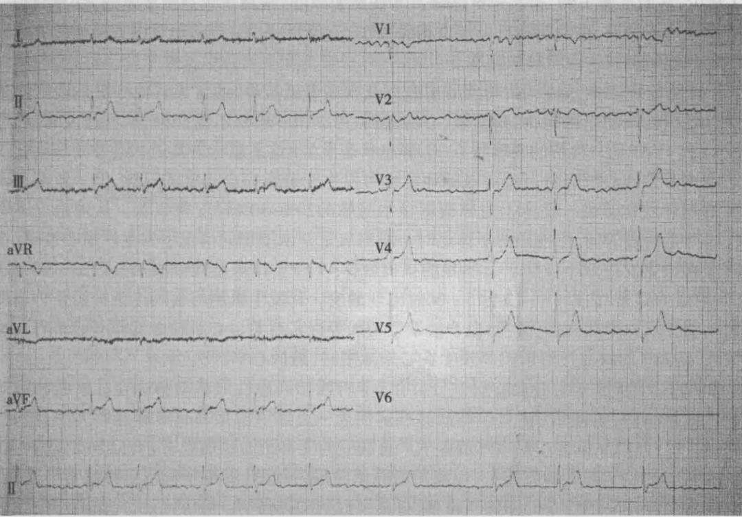 遇到这样的变异型心绞痛,如何快速诊断?