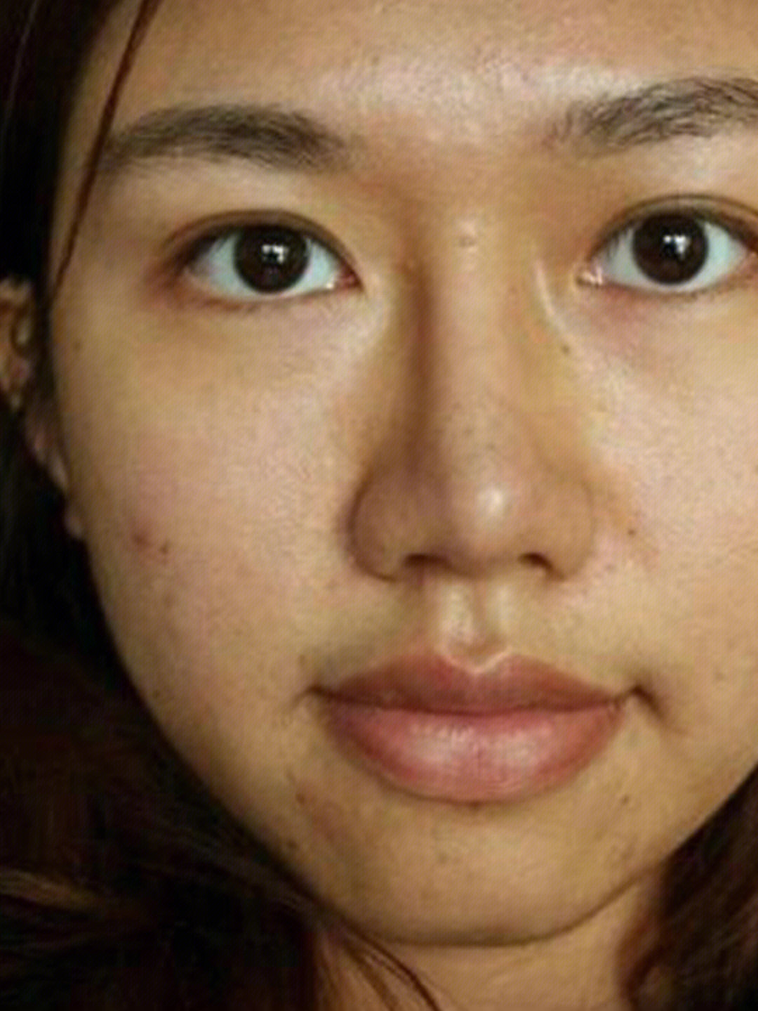 哪些医美项目可以改善皮肤暗沉?