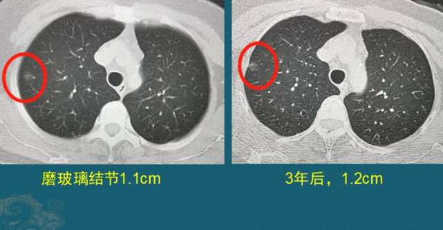 檢查出肺部陰影肺結節應該注意什麼醫生解釋3種情況