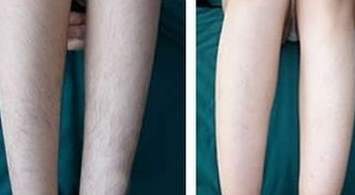 建议"体毛旺盛"的女生,试试这种明星脱毛方法,变美立竿见影