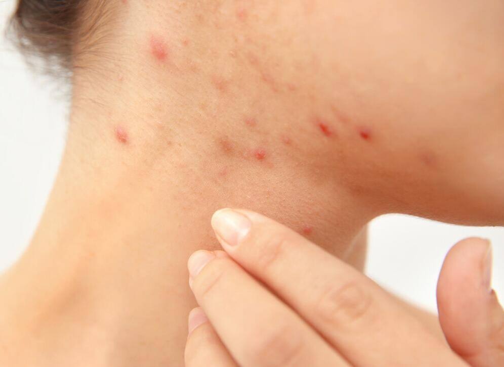 结节性梅毒疹是一种皮肤损害疾病,可由积极药物得以根治