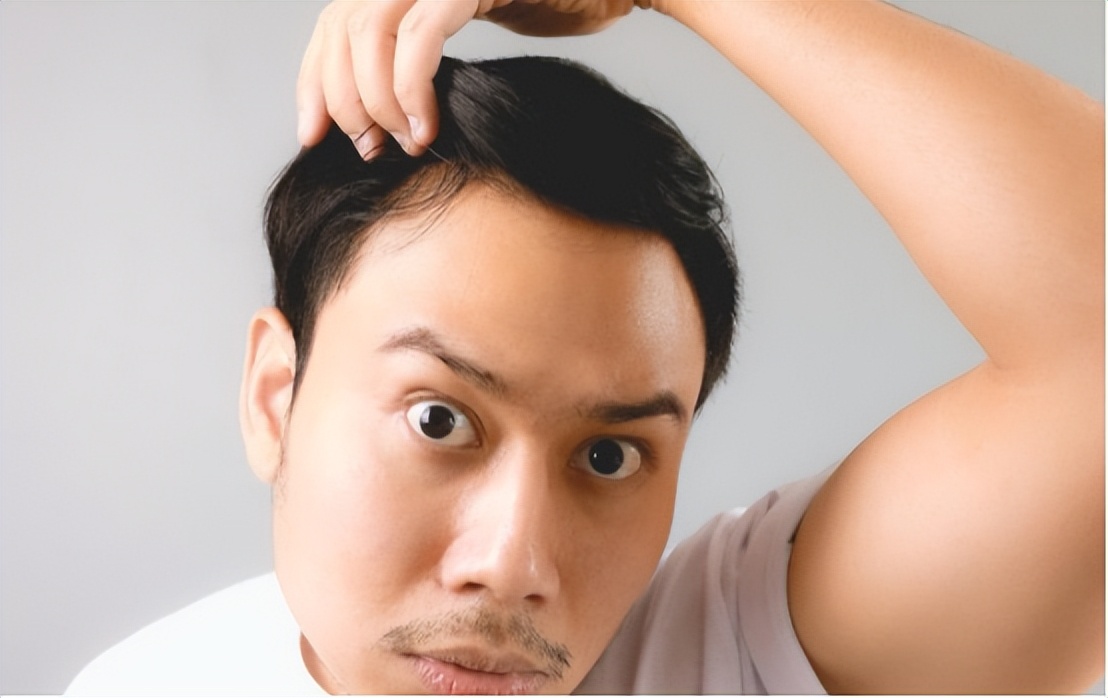 别人脱单你脱发!不想聪明"绝顶",治疗脱发最怕随大流的盲目