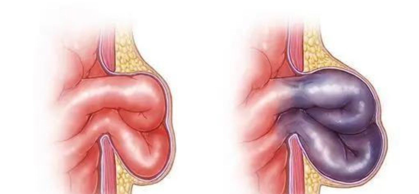 新生儿疝,主要包括新生儿膈疝,腹股沟疝和脐疝,不会遗传