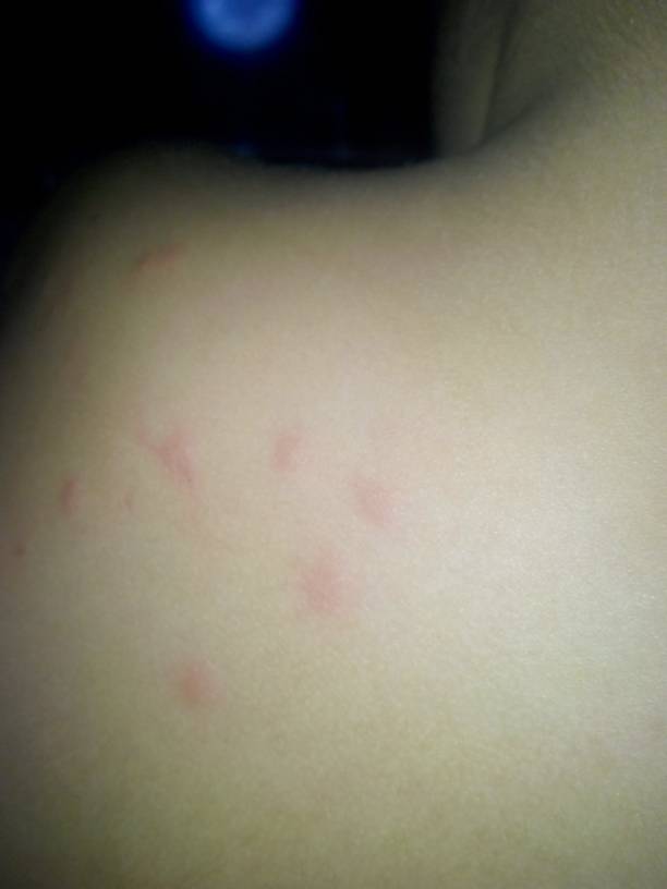 孩子后背痒和鸡皮疙瘩(孩子后背痒和鸡皮疙瘩一样)