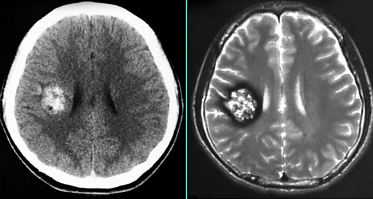 海绵状血管瘤及时就医,多为良性血管肿瘤,一般选择手术彻底切除