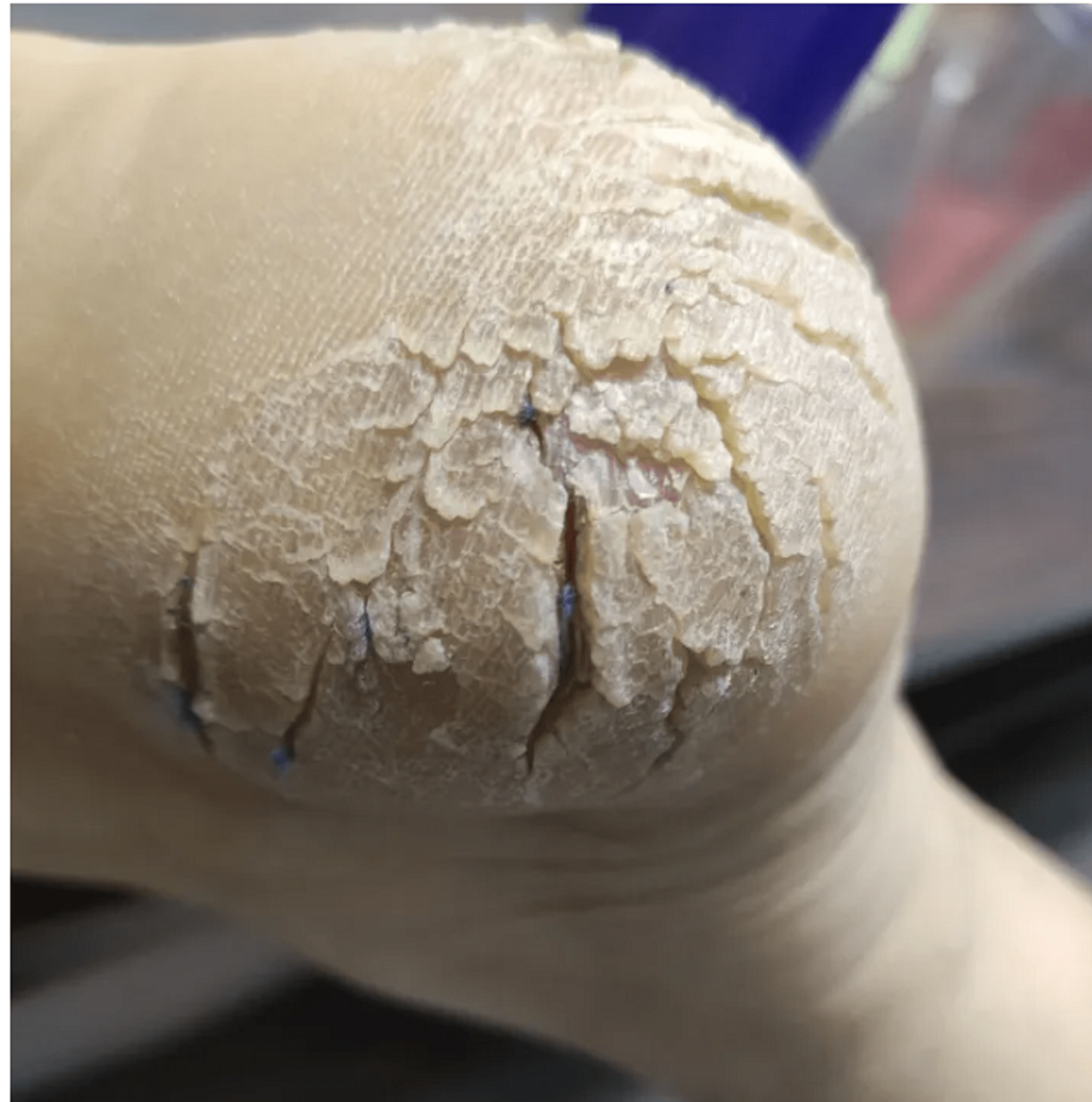 皲裂霜?别再被忽悠了,过来人支你1招诀窍!