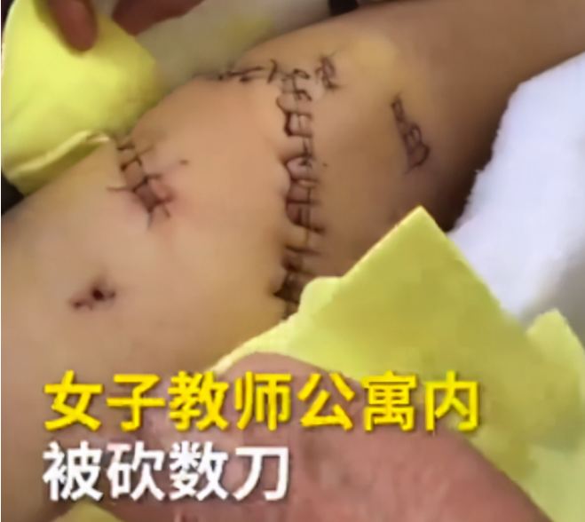 山西太原:一女教师宿舍内身中数刀,身上疤痕像"蜘蛛网"一样