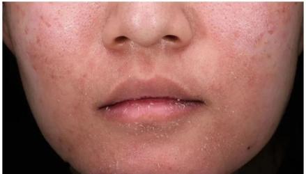 全国护肤日义诊| 解决皮肤敏感,衰老问题,报名即送一套敏感肌专用护肤