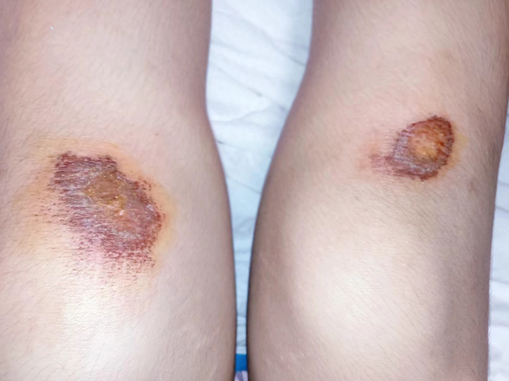 膝盖摔伤留疤难消除?过来人手把手教你3个步骤,疤痕逐步消退!