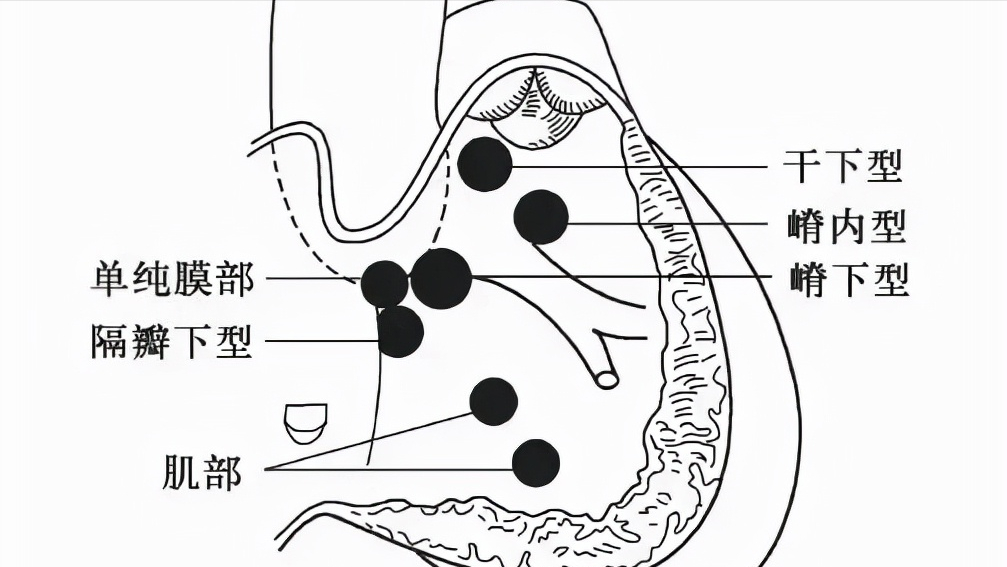 宝宝什么症状可能是室间隔缺损?