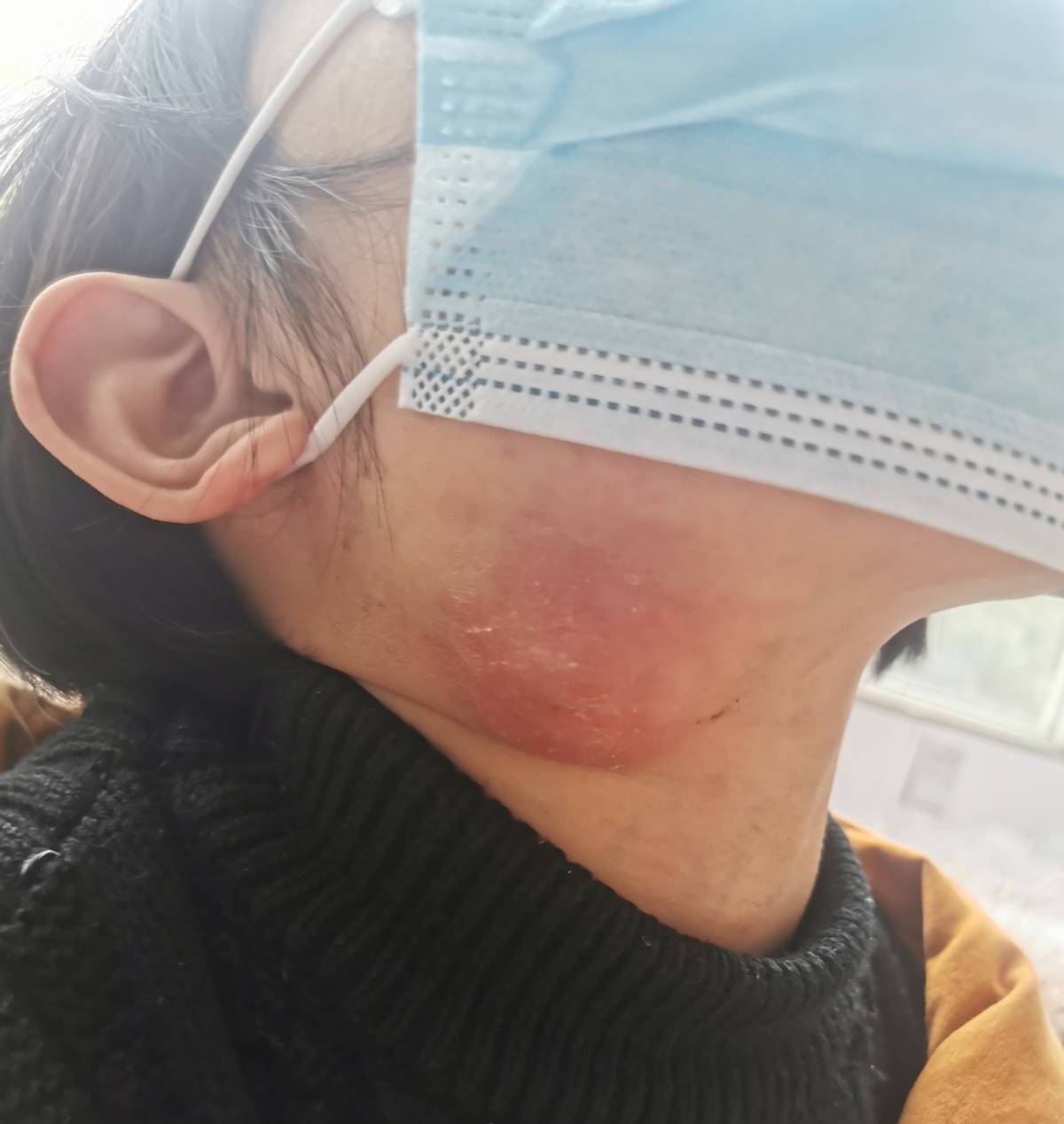 辗转求医路:南阳7岁女孩颈部淋巴结肿大 被误诊为腮腺炎