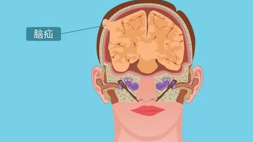 3个中成药,降血脂,抗动脉粥样硬化,保护心脑血管,建议了解!