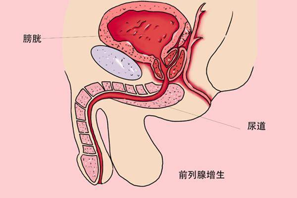 男人憋尿,容易憋出大事!
