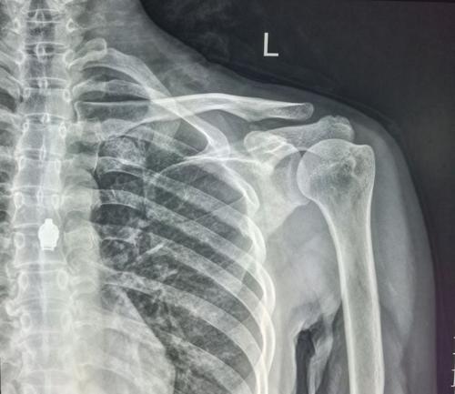 右肩膀骨折的片子照片图片