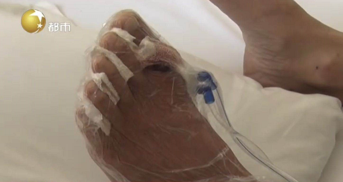 热点|男子被蚊子咬了一口,竟连做3次手术保命!这个动作可不能再做了