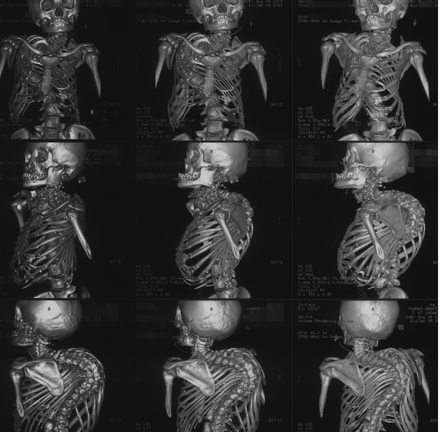 告别轮椅!分流术巧解脊髓空洞症患者行走难题!