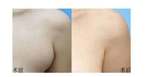 腋下多块肉是副乳吗?副乳怎么可以消除?