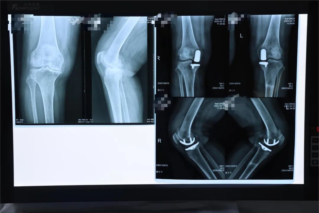 「新技术」充满"膝"望,我院成功实施双膝关节单髁置换术