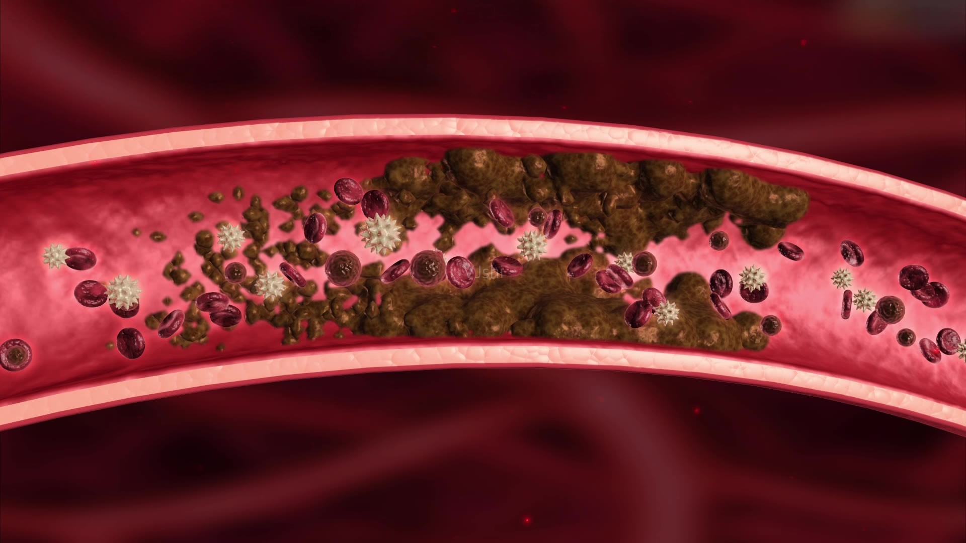 血管中真的有垃圾吗?堵塞血管的不是垃圾,而是它们,尽早了解