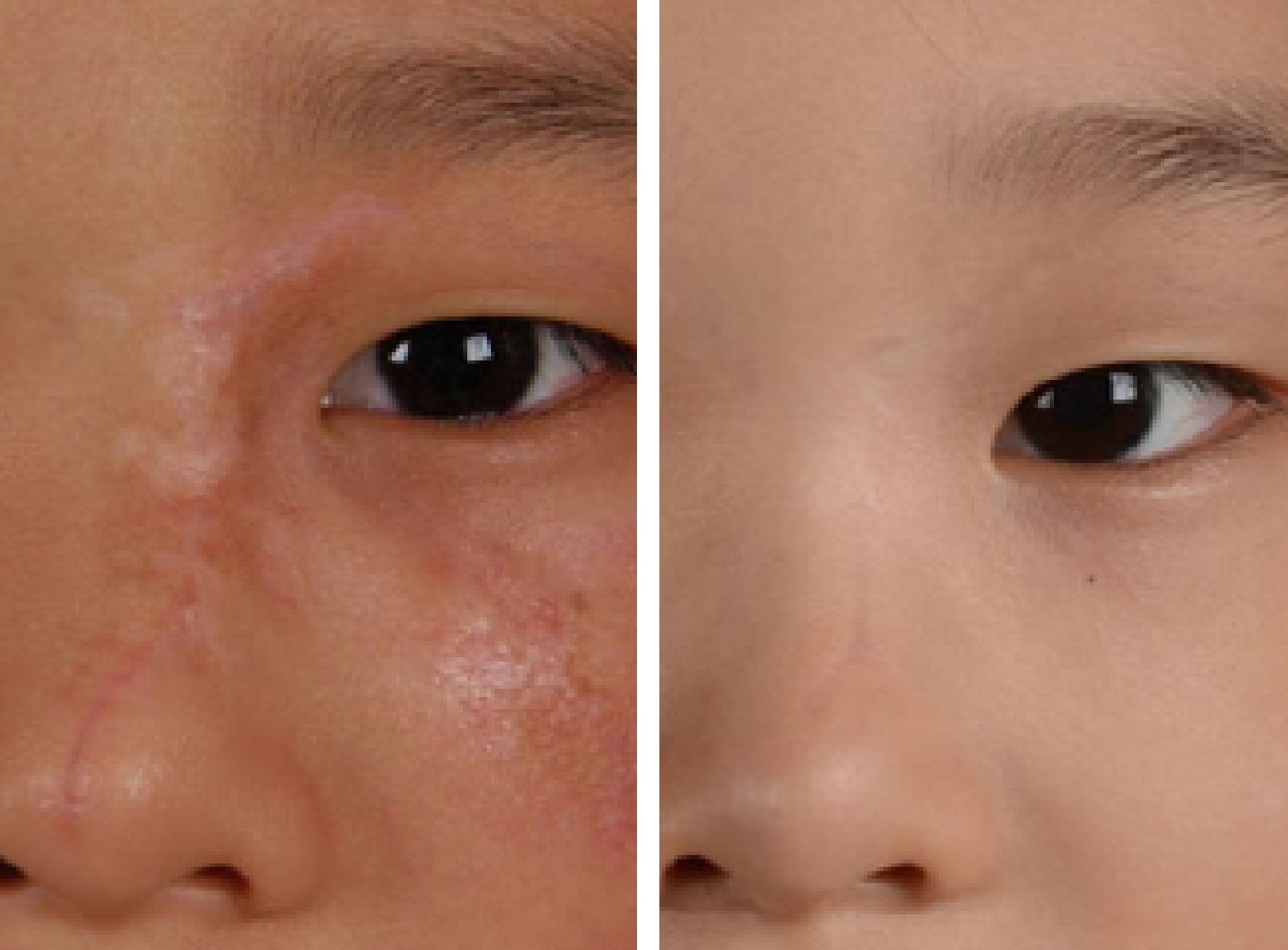 疤痕祛疤的方法可以根据不同的.@单音变美攻略的动态