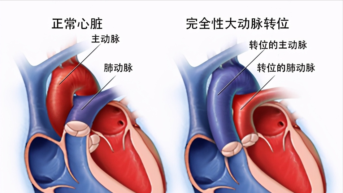 新生兒全身發紫,被確診完全性大動脈!還有得治嗎?