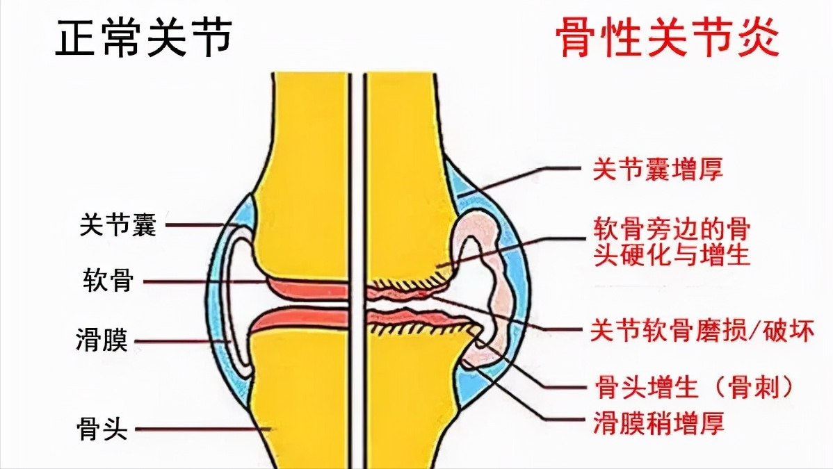 關節痛,分不清是痛風還是骨關節炎?醫生直言:3招教你輕鬆辨別