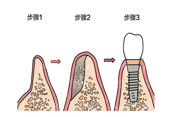 缺牙太久牙槽骨萎缩还能种牙吗?能,但大家别耽误修复时间