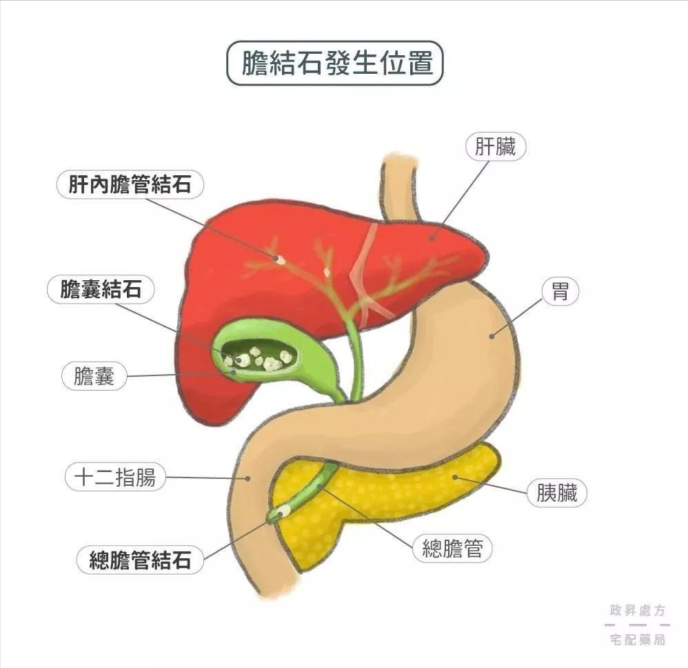 生酮饮食和胆结石的关系,低碳高脂饮食,减少胆结石的形成