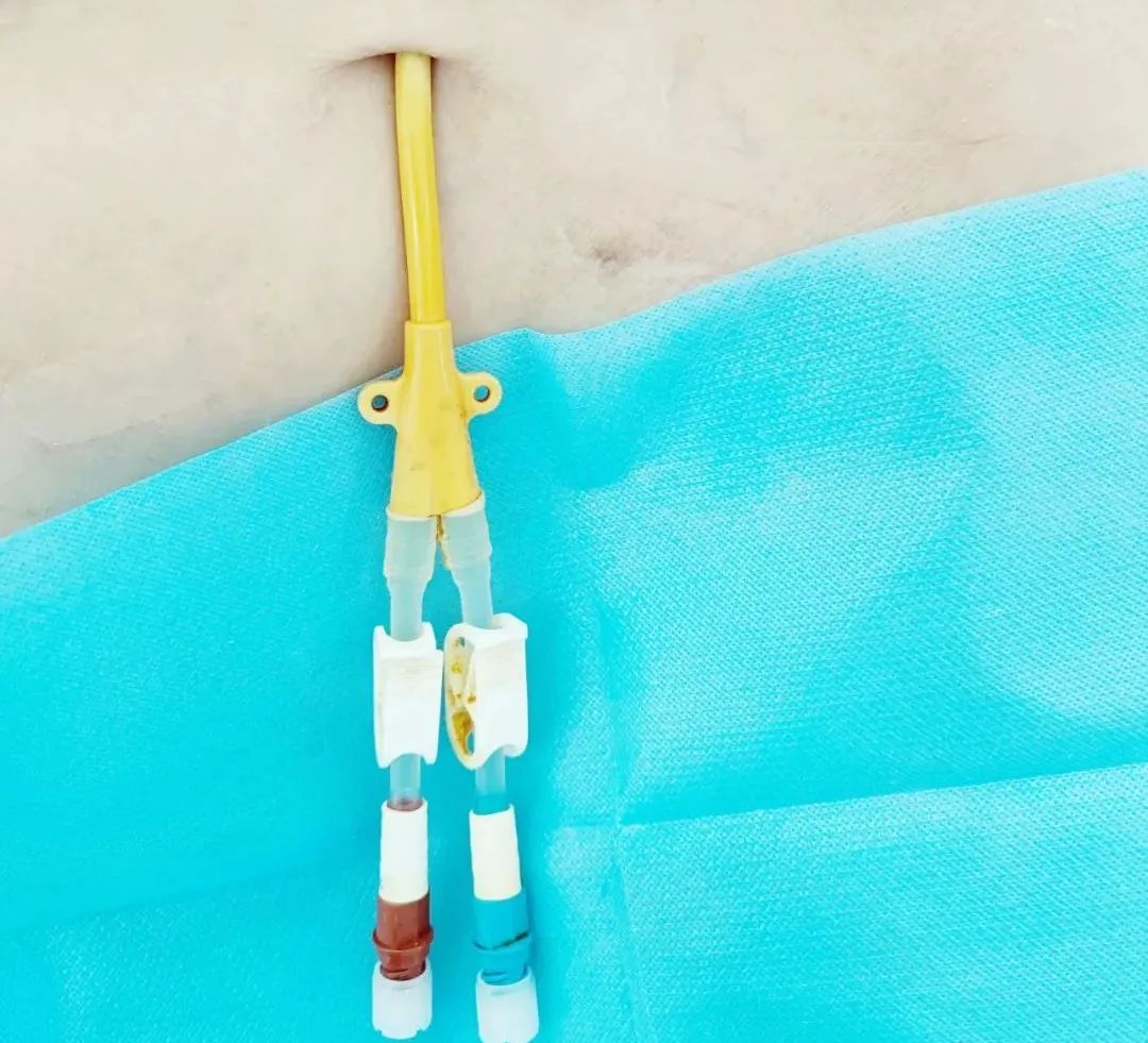 「积医科普」血管通路小组在行动——保卫血液透析患者"生命线"(一)