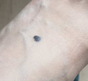 推荐速低头，找痣！知名医生：长在这些地方的都要切除！