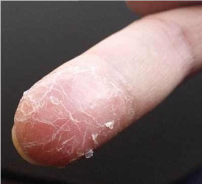 手指尖的皮肤变硬,开裂,脱皮,疼痛,这种症状在医学上称之为指尖的角化