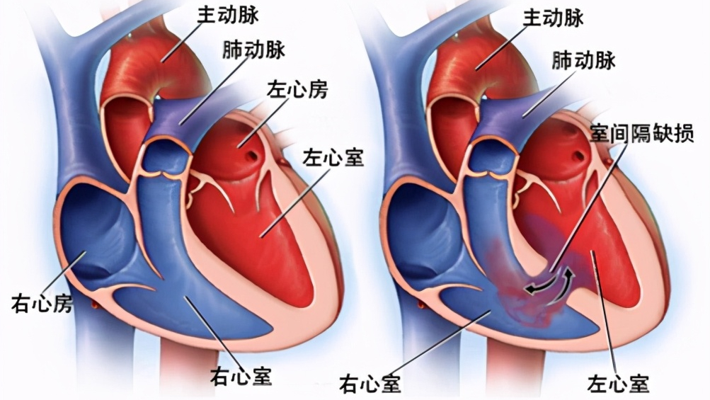 艾森曼格综合征是怎么回事儿?它应该如何治疗?