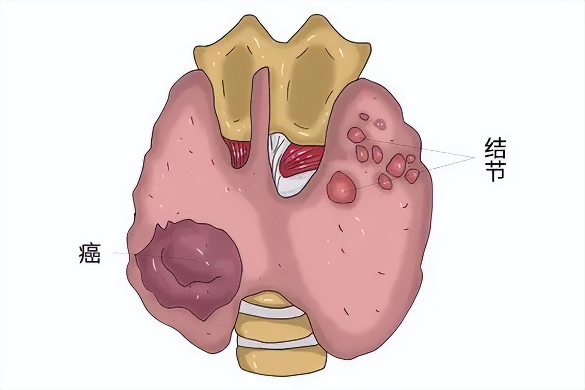 甲状腺结节如何判断良性还是恶性?