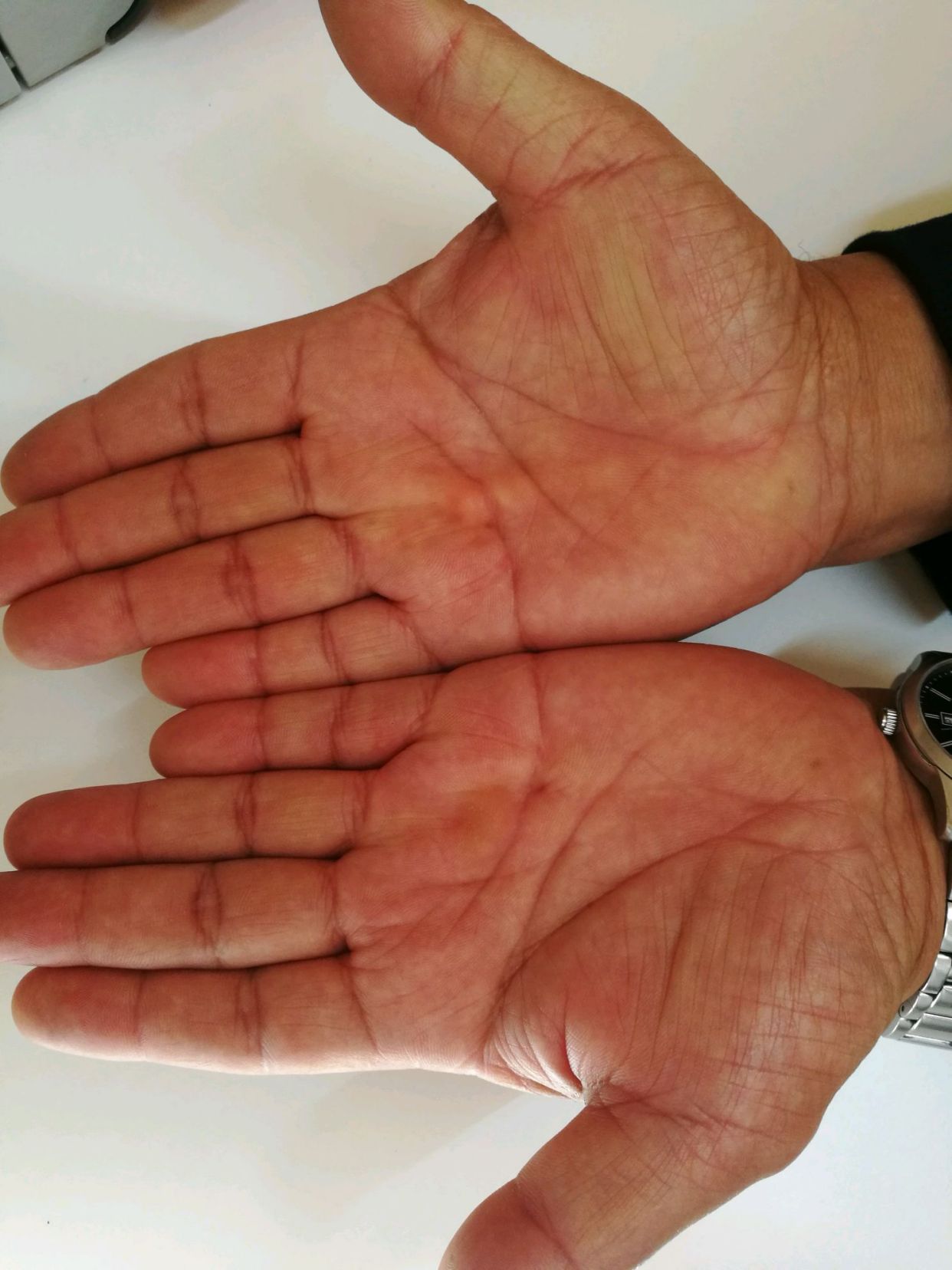 掌跖角化病,一种遗传性角化性皮肤病,此病大部分患者都有家族史