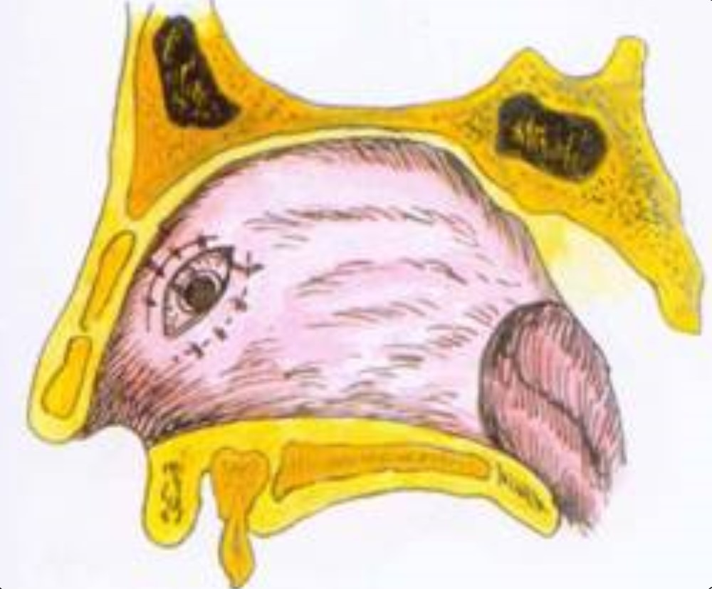 创伤性鼻中隔穿孔,多由头,面,鼻部外伤引起,可能并发嗅觉减退