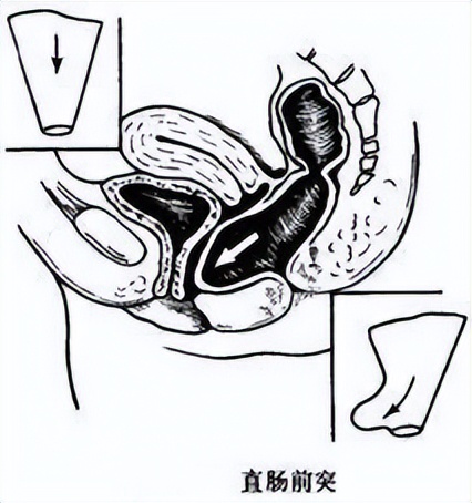 「科普」什么是直肠前突?怎么引起的?