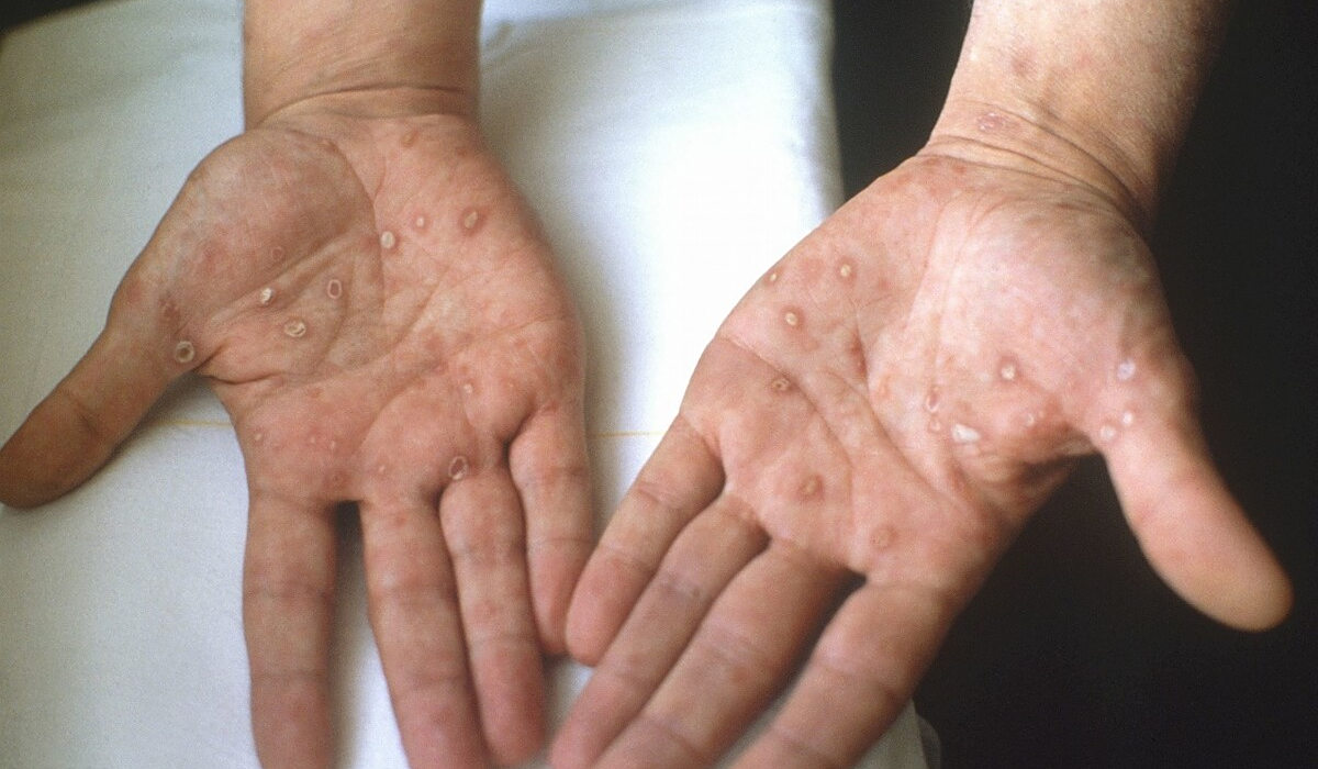 梅毒是一种什么样的病?