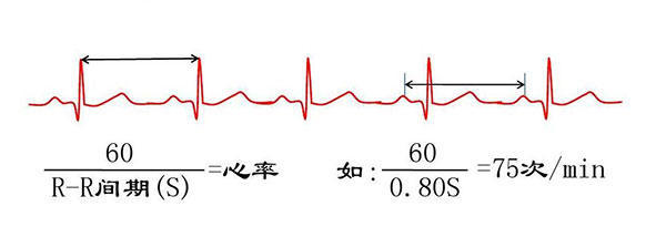 心电图rv6十sv2正常值图片